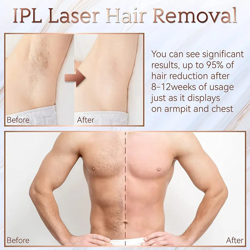 SilkPulse™ – 999,999 Flash IPL Hair Removal System